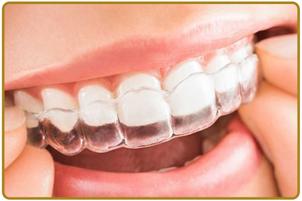 Aligner Treatment